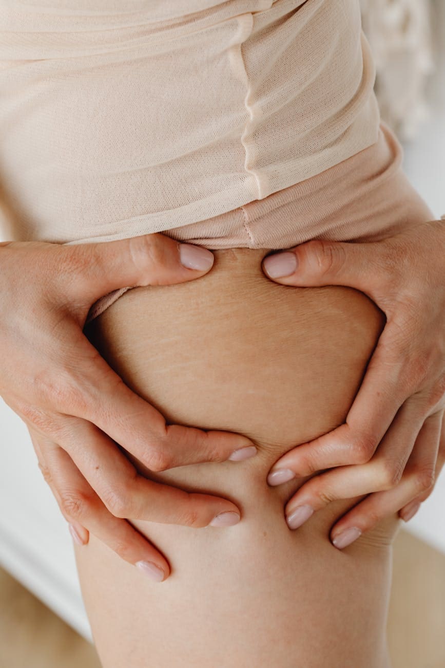 a person holding a bodypart with stretchmarks